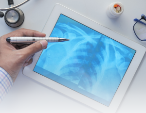 Pacientes com sobrecarga de ferro apresentam um risco 55% maior de qualquer fratura óssea