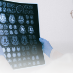 Depressão emergente foi associada à patologia mais precoce do Alzheimer