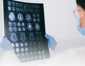 Depressão emergente foi associada à patologia mais precoce do Alzheimer