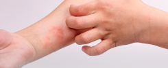 Dermatite Atópica Infantil